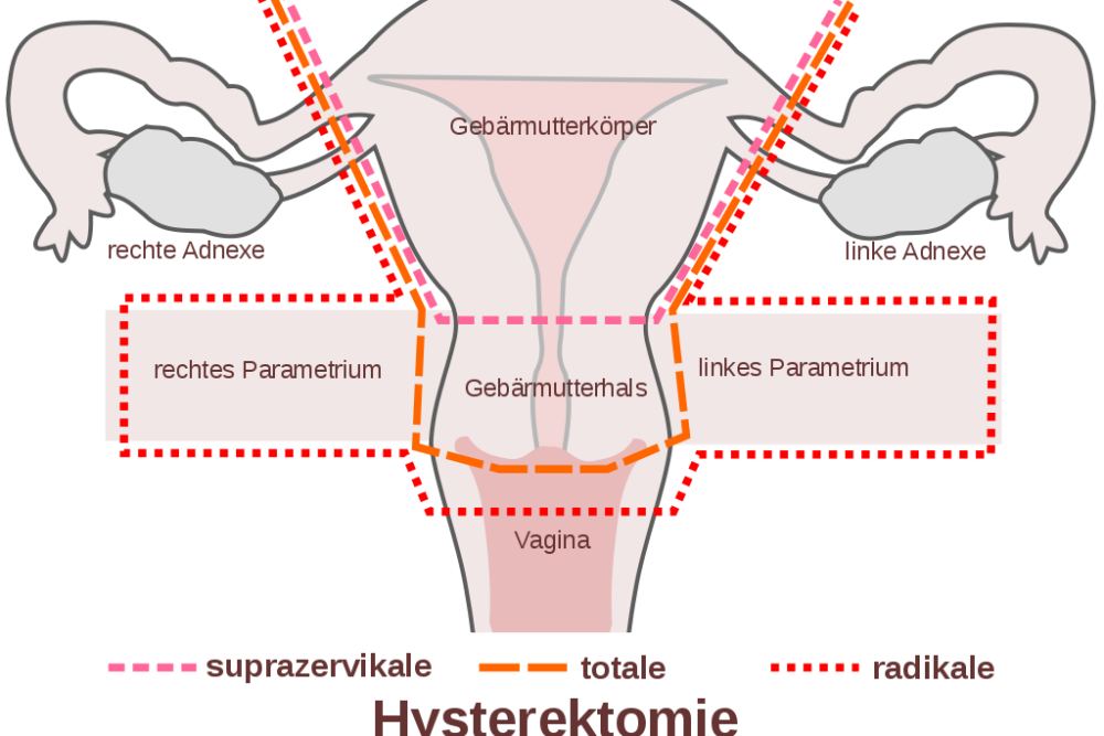 Schema Hysterektomie